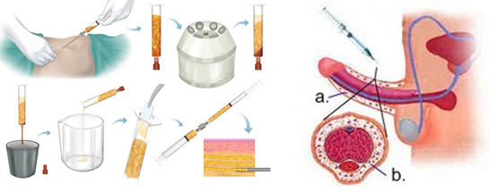 Magnification-penoplasty